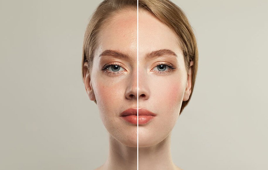 8 Effects of Stress on Skin and Ways to Cope with It